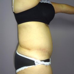 Manhattan abdominoplasty after 13